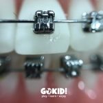 Ortodontia la copii 7 semne avertisment la copil 7 ani gokid